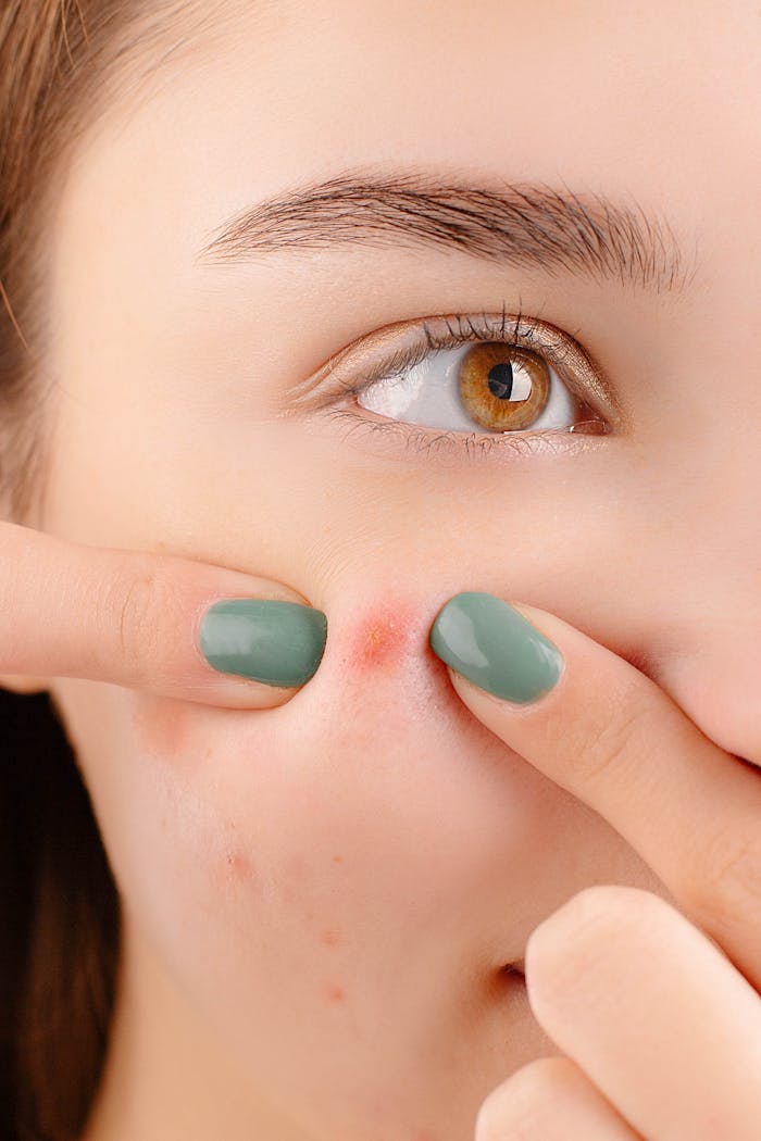 A young woman squeezing a pimple on her face, showing skin irritation and acne details in a studio setting.